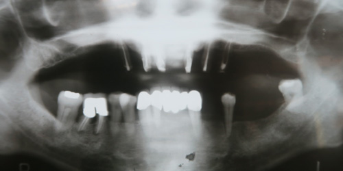 上下顎の多数歯欠損をインプラント治療により補綴した症例 K様：治療について：症例集｜六本木の歯医者・歯科・入れ歯（コーヌス義歯）・小児歯科なら