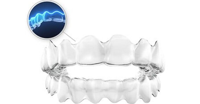 マウスピース矯正