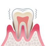 歯周病の進行と治療