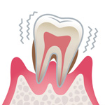 歯周病の進行と治療